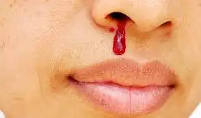 Nasal Bleeding Homeopathic Treatment in Lucknow, India