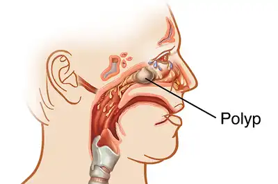 Nasal Polyps Homeopathic Treatment in Lucknow India