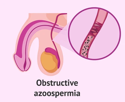 Obstructive Azoospermia Homeopathic Treatment in Lucknow