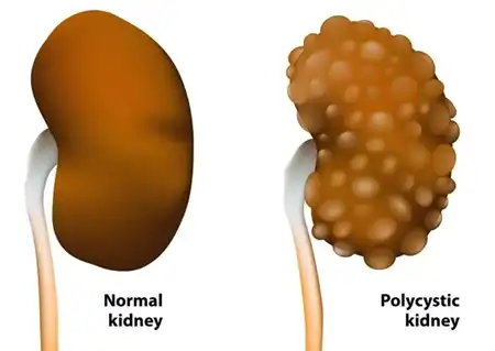 Polycystic Kidney Disease (PKD) Homeopathic Treatment in Lucknow India