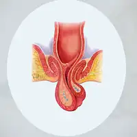 Rectal Prolapse Treatment in Lucknow, India