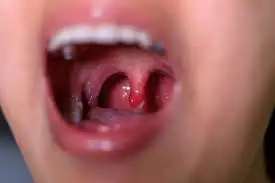 Tonsillitis Homeopathic Treatment in Lucknow India