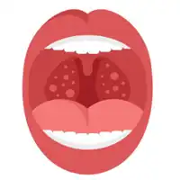 Tonsillitis