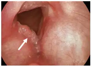 Vocal Cord Tumour Homeopathic Treatment in Lucknow