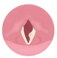 Vocal Polypse Treatment in Lucknow India