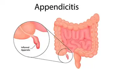 Appendicitis Homeopathy Treatment in Lucknow India