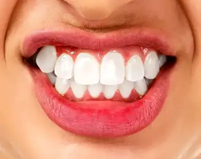 Bruxism (Teeth Grinding) Homeopathic Treatment in Lucknow, India