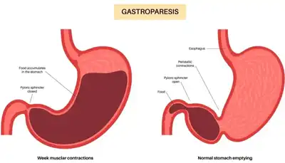 Gastroparesis Homeopathic Treatment in Lucknow, India