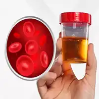 Hematuria Treatment in Lucknow, India