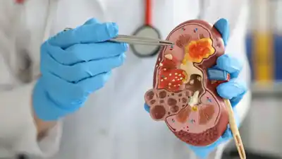 Kidney Failure Homeopathic Treatment in Lucknow, India
