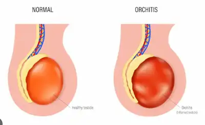 Orchitis Homeopathic Treatment in Lucknow, India