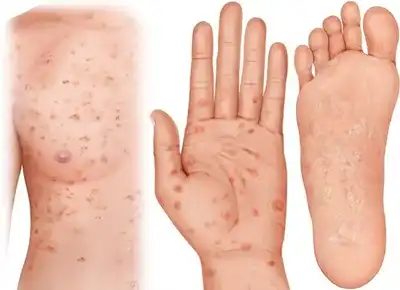 Syphilis Homeopathic Treatment in Lucknow, India