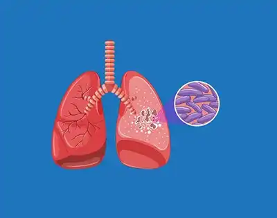 Tuberculosis (TB) Homeopathic Treatment in Lucknow, India