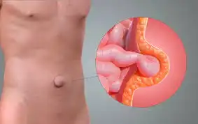 Umbilical Hernia Homeopathic Treatment in Lucknow India