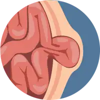 Umbilical Hernia Treatment in Lucknow