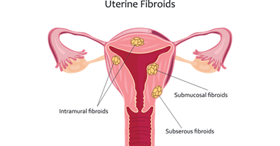 Uterine Fibroids Treatment in Lucknow India