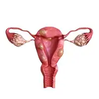 Uterine Fibroids