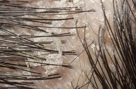 Dandruff Treatment in Lucknow India