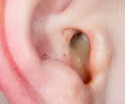 Ear Infection