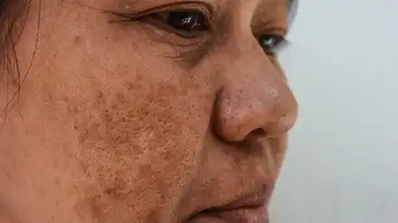 Melasma Treatment in Lucknow India