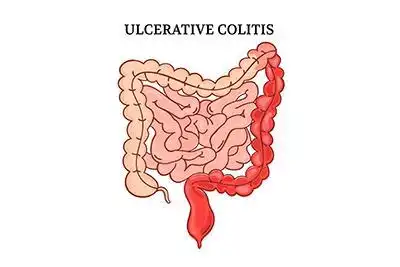 Ulcerative Colitis Treatment in Lucknow