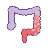 Ulcerative Colitis