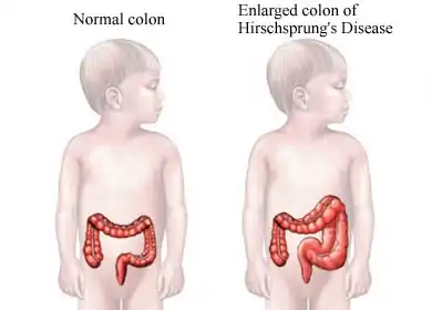 Hirschsprung Disease Treatment in Lucknow India