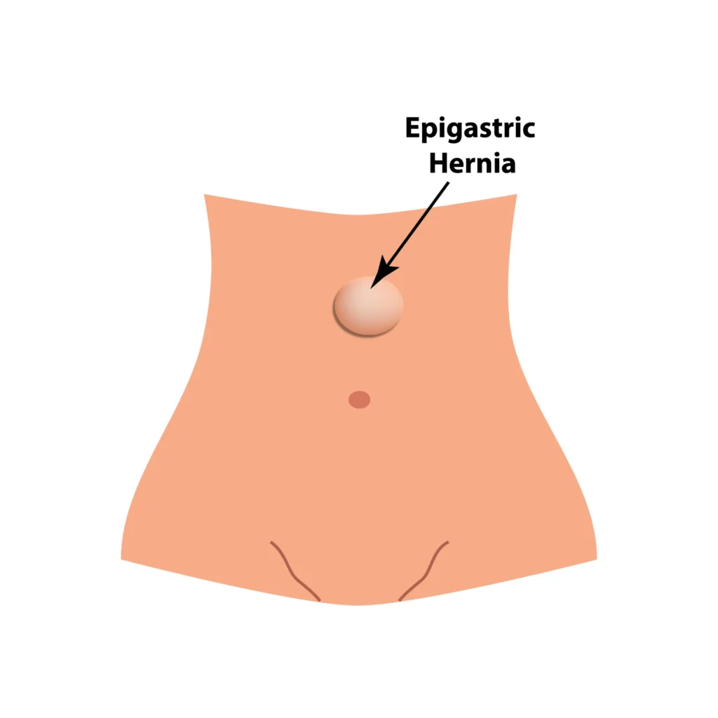 Epigastric Hernia in Children