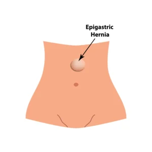 Epigastric Hernia in Children