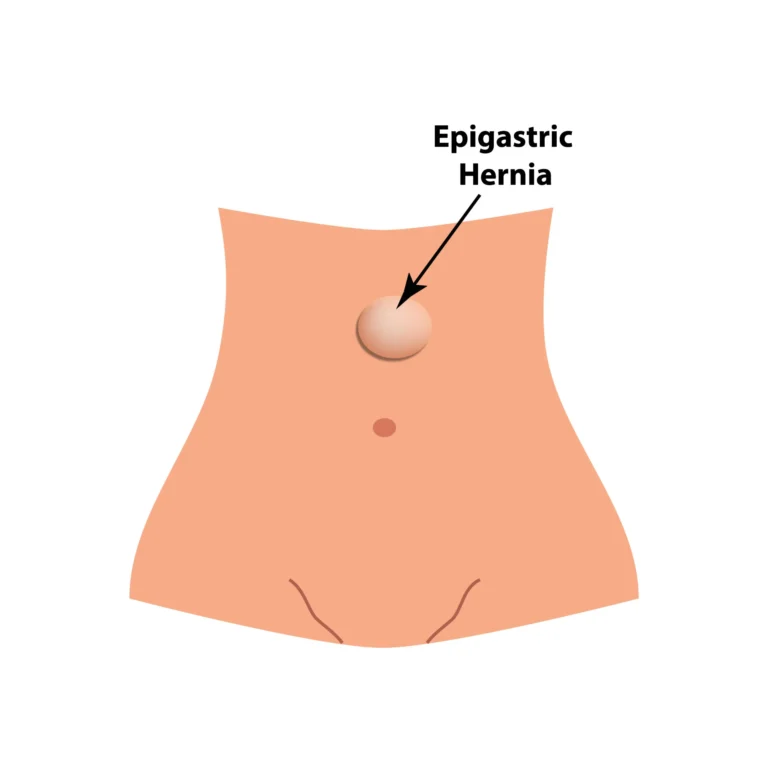 Epigastric Hernia in Children
