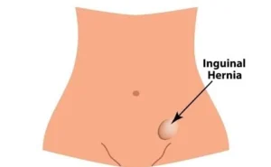 Inguinal Hernia in Children