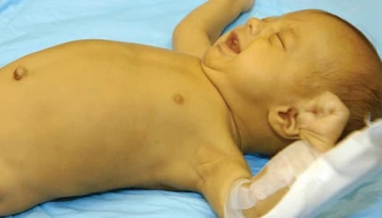 Pediatric Jaundice