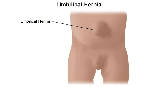 Pediatric Umbilical Hernia
