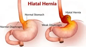 Hiatal Hernia in Children