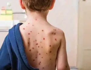 Chickenpox in Children