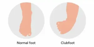 Clubfoot in Children