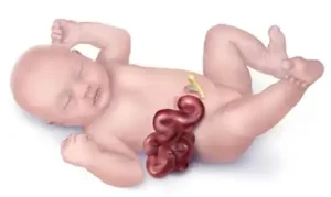 Gastroschisis in Children