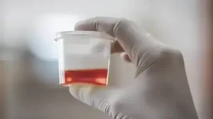 Hematuria (Blood in the Urine) in Children