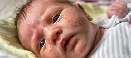 Acne in Children