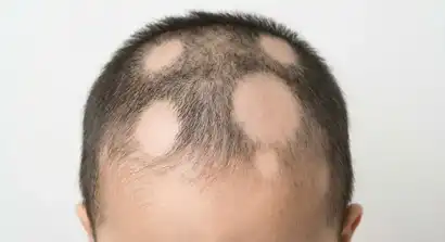 Alopecia Areata in Children