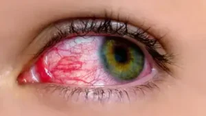 Conjunctivitis (Pink Eye) in Children
