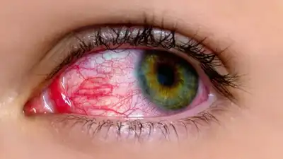 Conjunctivitis (Pink Eye) in Children