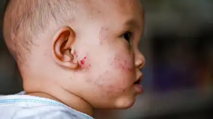 Eczema (Atopic Dermatitis) in Children