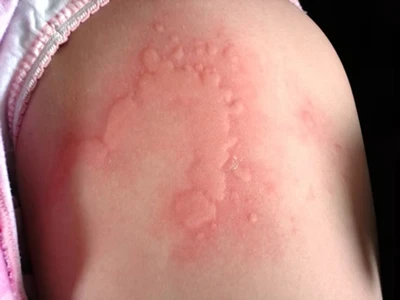 Hives (Urticaria) in Children