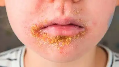 Impetigo in Children