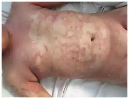 Psoriasis in Children