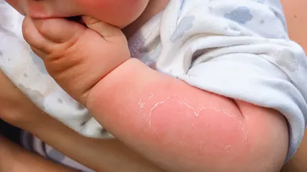 Sunburn in Children