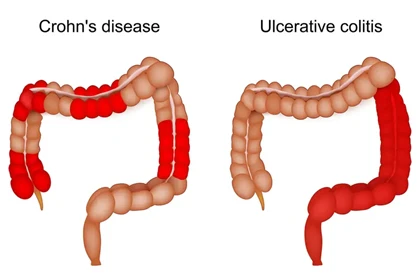 Ulcerative Colitis in Children