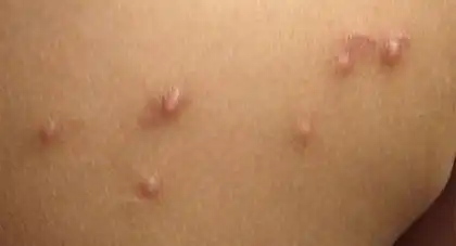 Warts in Children