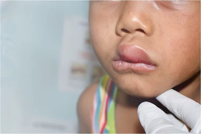 Angioedema in Children